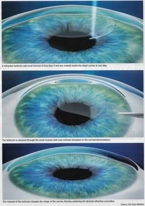 SMILE Eye Surgery