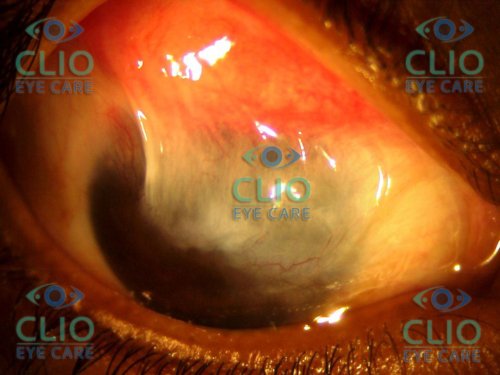 Chronic chemical burn with lime (chuna)