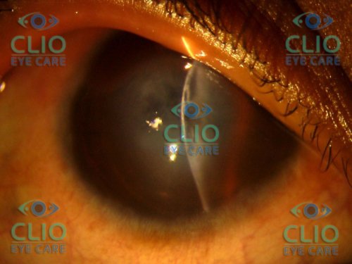 Acute hydrops in keratoconus