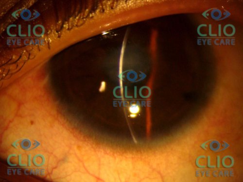 Resolved after treatment with Gas injection