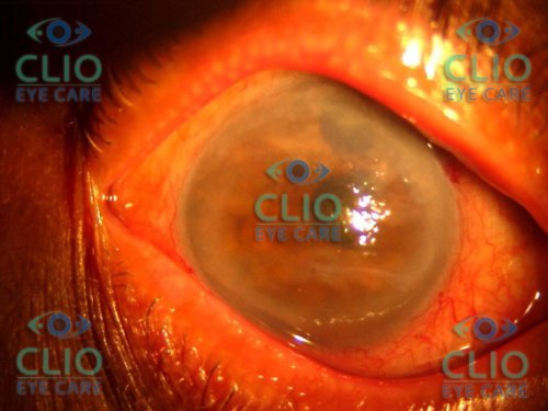 Pseudophakic corneal oedema