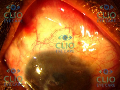 Post op picture after ocular surface reconstruction with Limbal stem cell Transplant