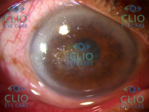 Corneal Dystrophy 
