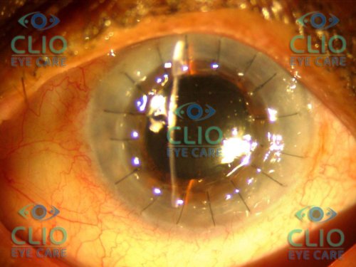 Post Op Corneal transplant with cataract surgery and IOL implant