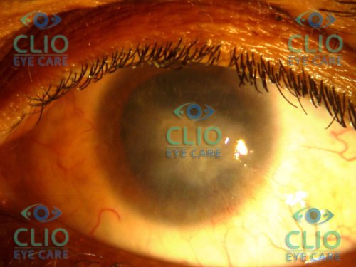 Corneal opacity with limbal deficiency