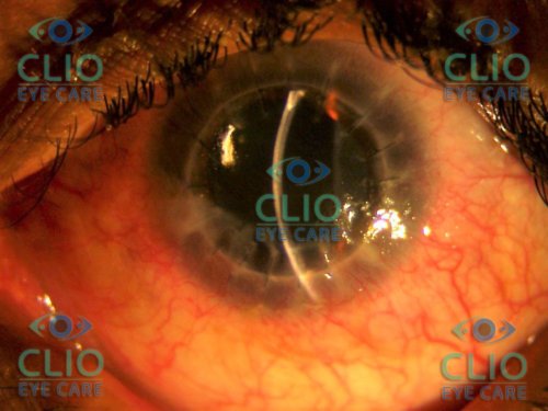 Post op Corneal transplant and limbal stem cell transplant