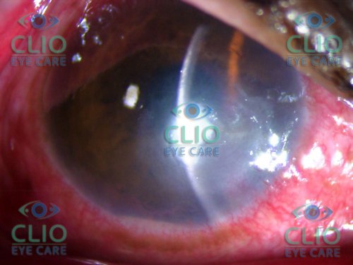 Corneal Ulcer healed with treatment
