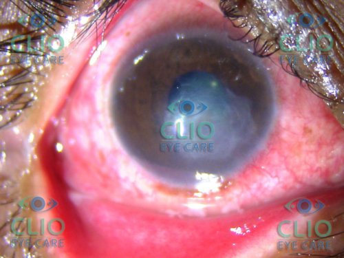 Corneal Ulcer healed with treatment