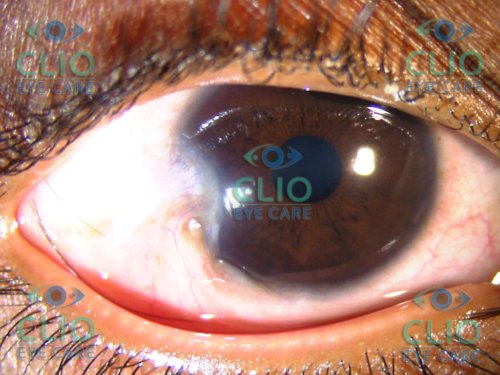 Limbal Dermoid