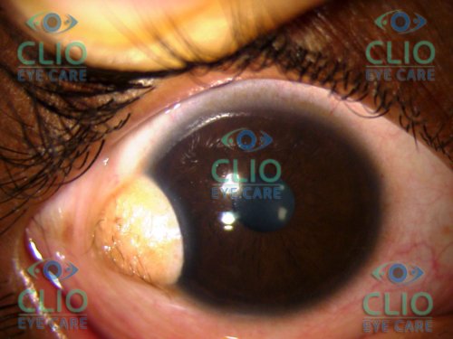 Limbal Dermoid